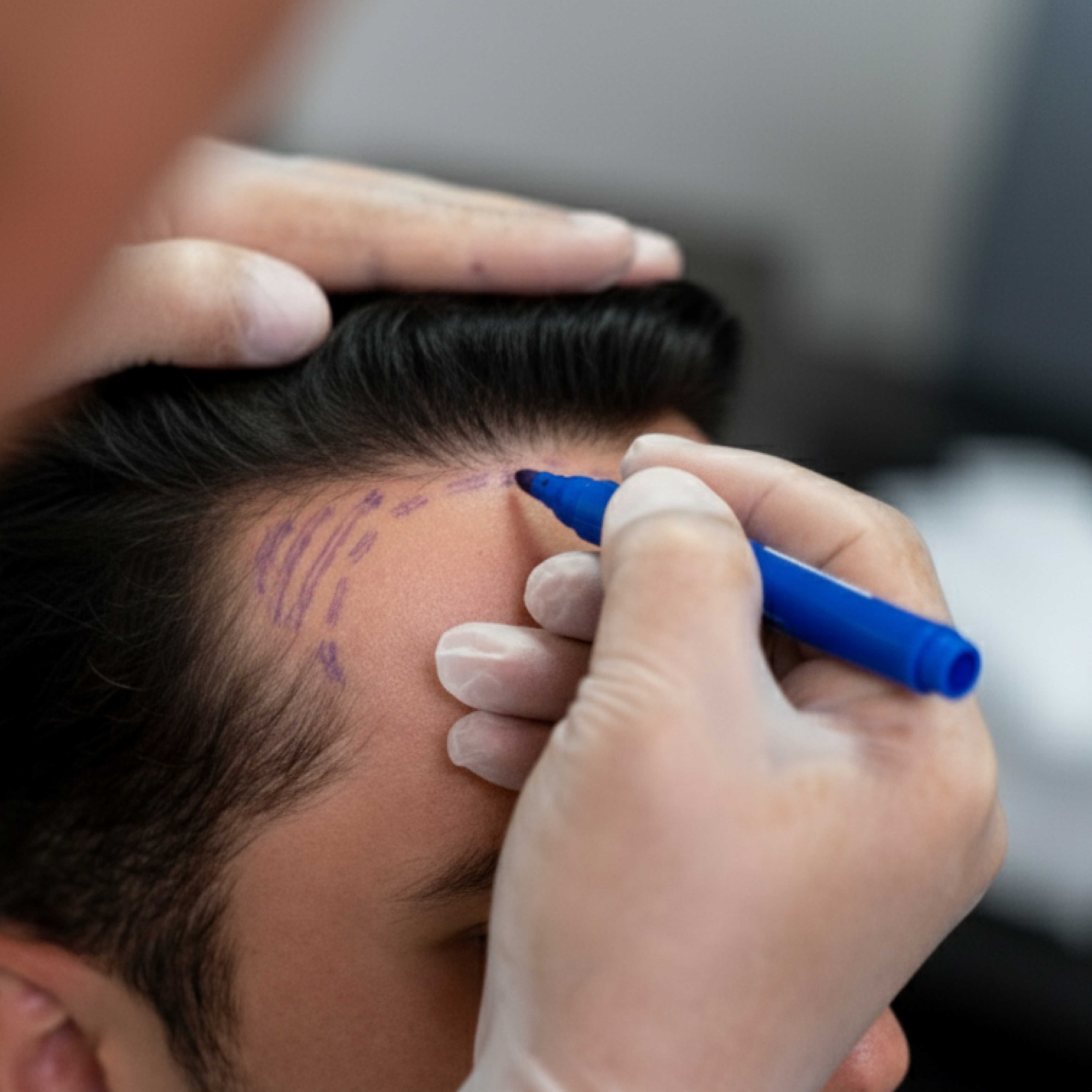 Hair transplantation