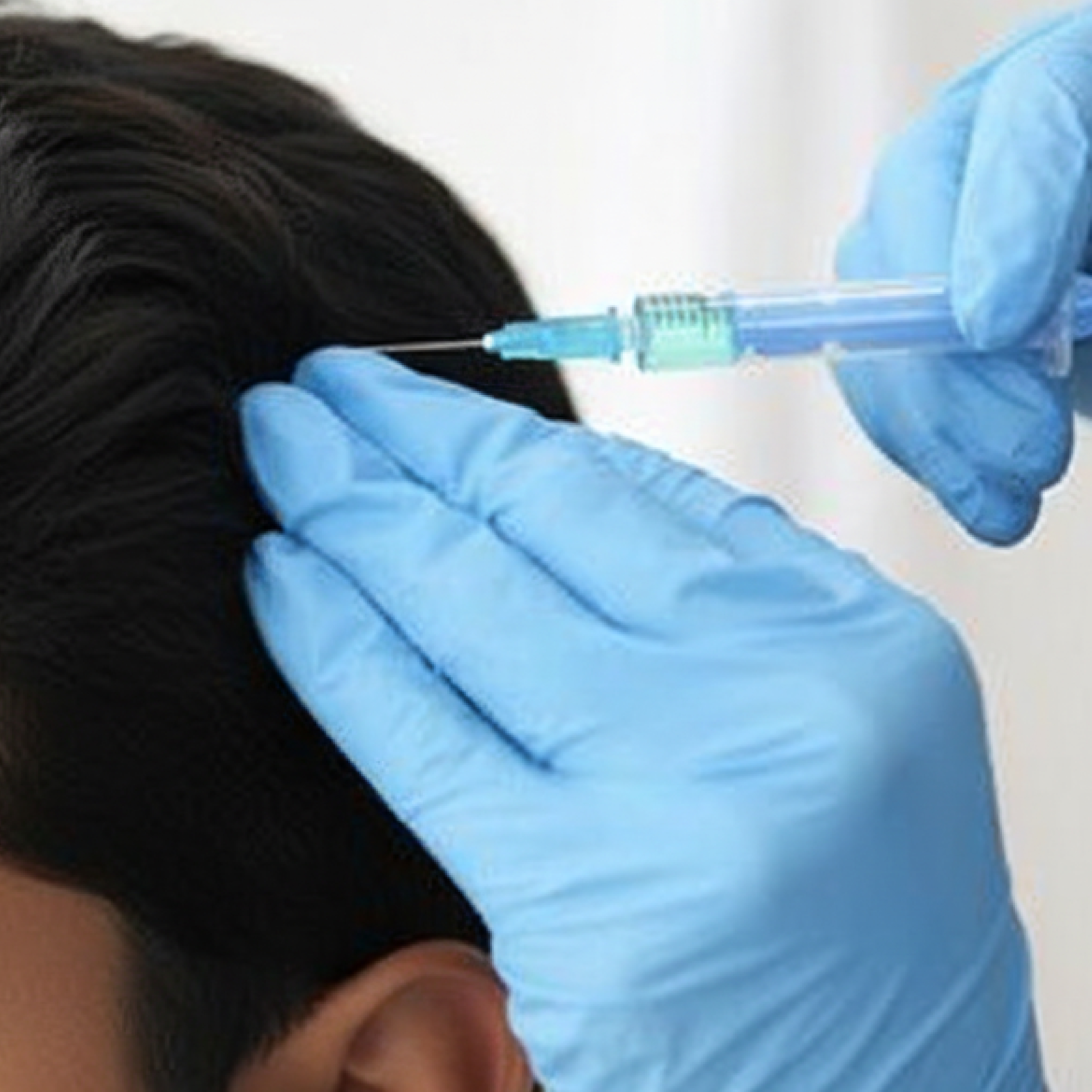 QR678 treatment with syringe injection to scalp